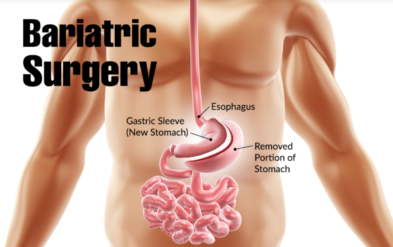 Bariatric / Metabolic surgery
