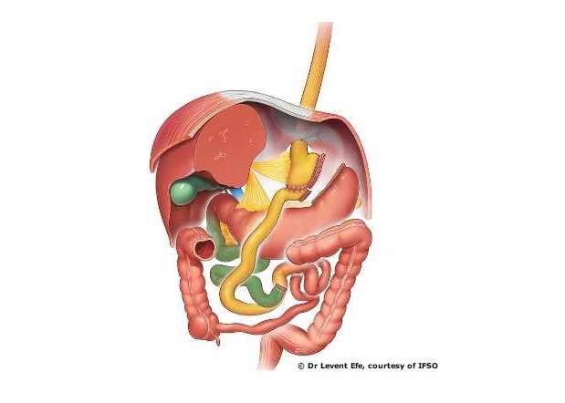 Bariatric / Metabolic surgery