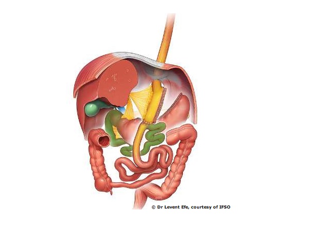 Bariatric / Metabolic surgery
