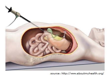 Bariatric / Metabolic surgery